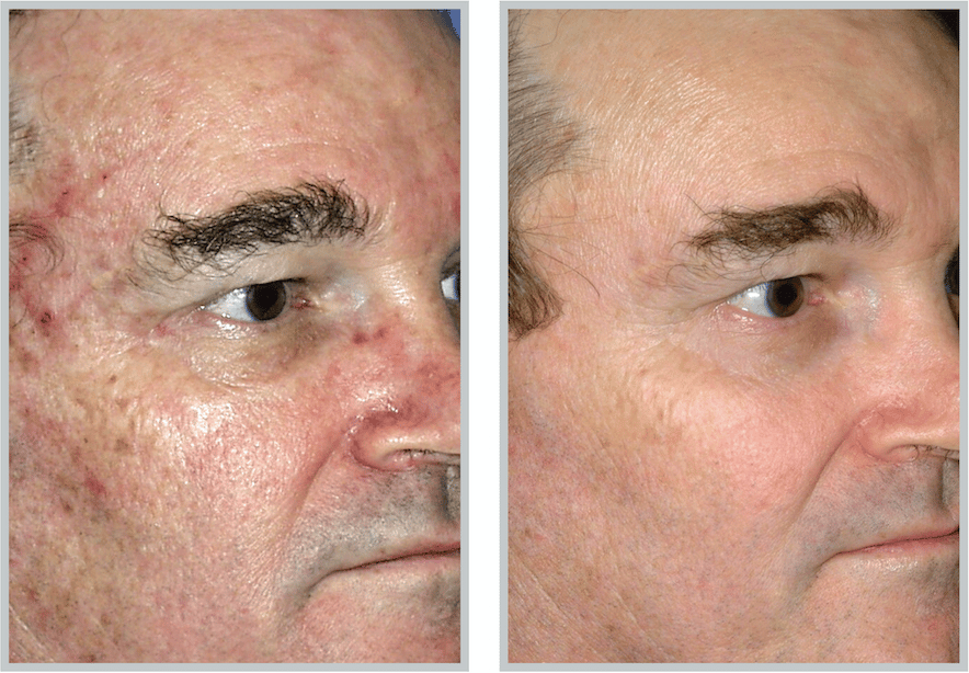 Male patient Microlaser peel before and after at ONG plastic Surgery Institute