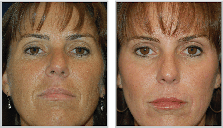 Female front facing before and after micropeel laser treatment
