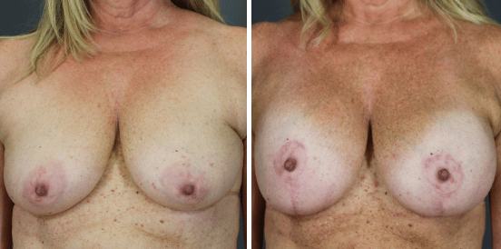 Breast lift in Scottsdale AZ | Mastopexy Scottsdale AZ